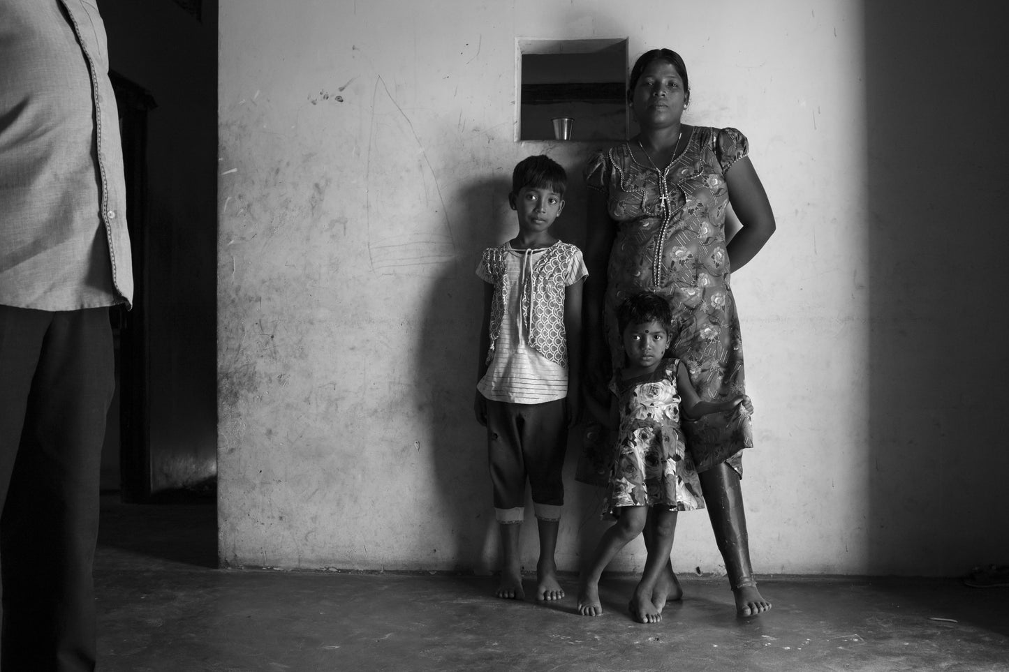 A woman with a prosthesis following the civil war in Sri Lanka